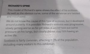 Richard's scoliosis explained
