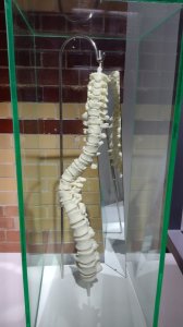 Reconstruction of Richard's spine